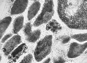 M,3y. | mast cell - granules with scroll-like formations - n. suralis, Krabbe globoid leukodystrophy